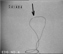Enlarged X-ray Photo of Resistance Element Disconnection Image